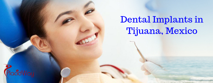 Dental Implants In Tijuana Mexico 10 Questions To Ask Dentist